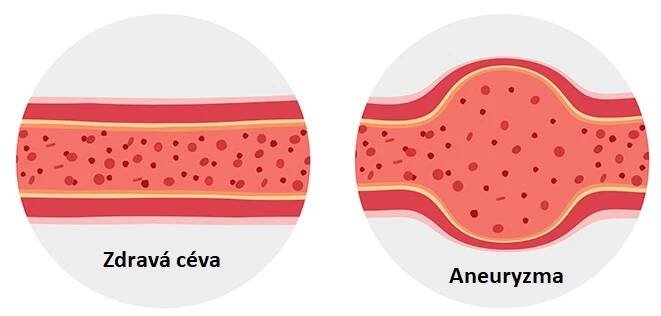 Aneurysma aorty – co je to – příznaky, příčiny a léčba