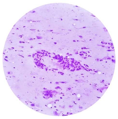 mikrosnímek ukazující neurofibrom. neurofibromatóza je genetická porucha, genové mutace. - neurofibromatóza - stock snímky, obrázky a fotky