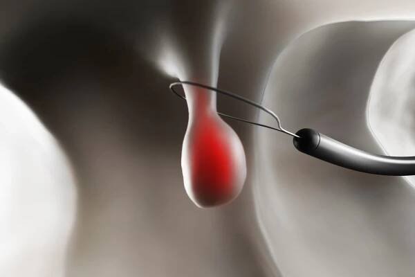 Removing a polyp illustration