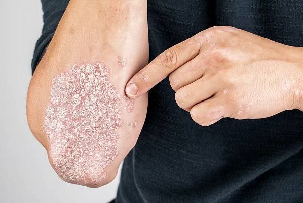 Bimekizumab ve 3. linii biologické léčby po selhání risanki...