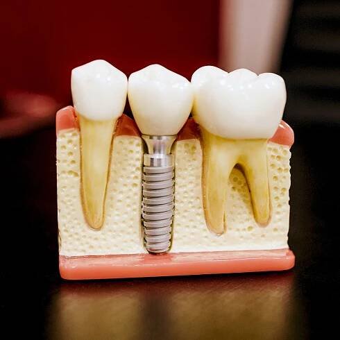 zubní implantát: umělá náhrada zubu