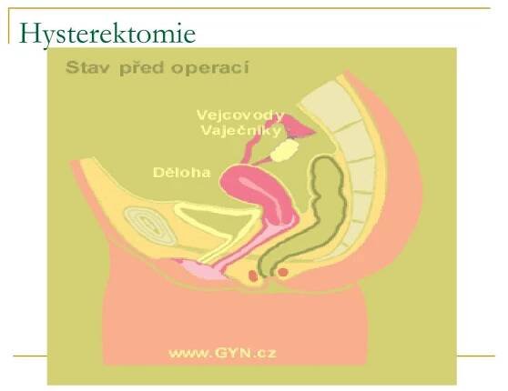 PPT - Gynekologické operace PowerPoint Presentation, free download - ID:4187238