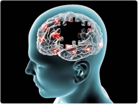 10+ Výkonné Alzheimerova choroba Domácí opravné prostředky