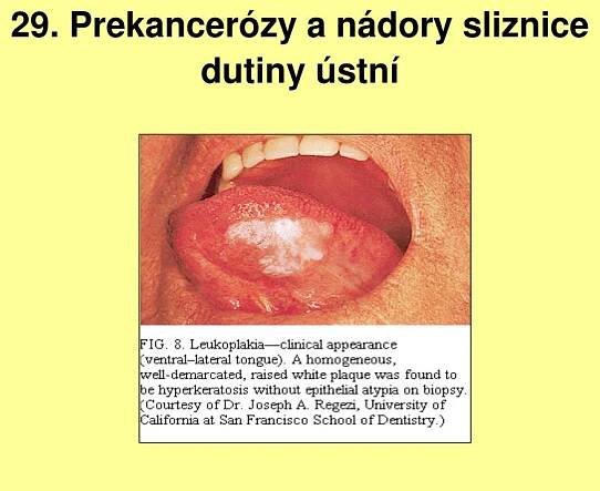 PPT - 21. Granulomy ústní sliznice PowerPoint Presentation, free download - ID:925540