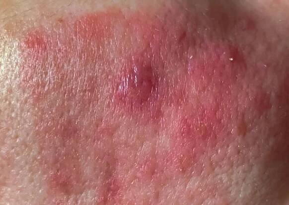 detail, selektivní zaměření, dermatologická infekce kůže, při které zarudnutí a vyrážky na kůži obličeje - trudník - stock snímky, obrázky a fotky