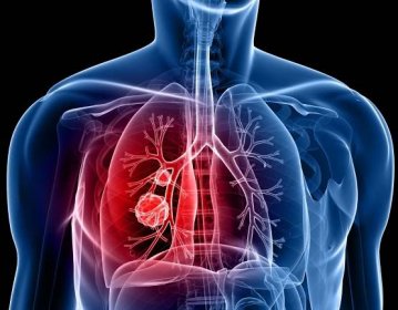 Pneumonie je závažný problém, který je nutný řešit včas, jinak může mít fatální následky