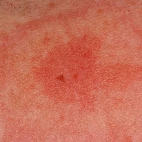 Contact allergy (overview)
