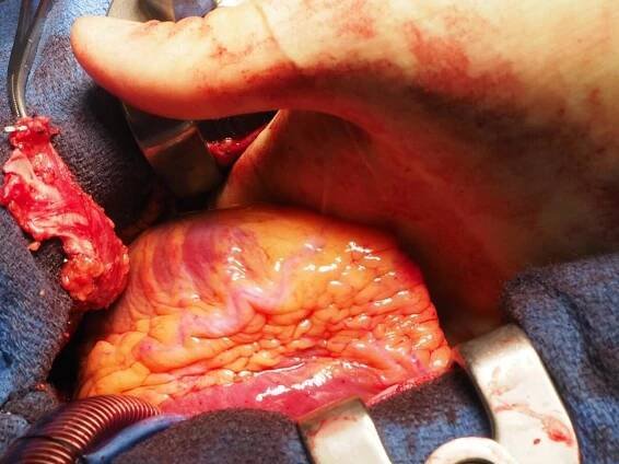 front-coronary