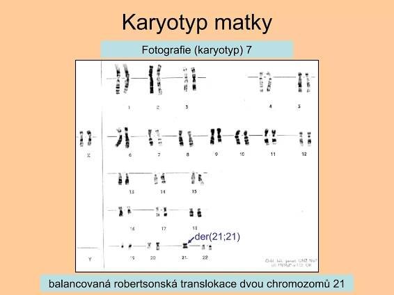 Karyotyp matky balancovaná robertsonská translokace dvou chromozomů 21 Fotografie (karyotyp) 7 der(21;21) 