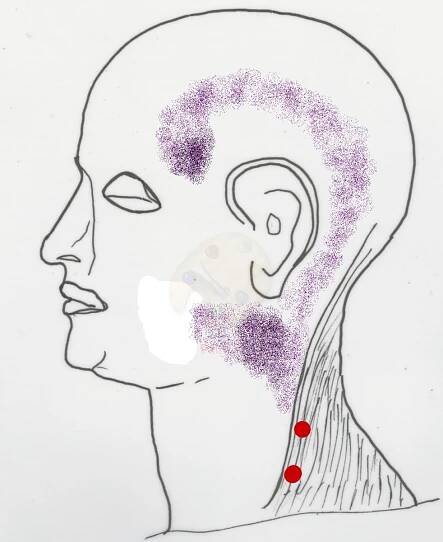 Trigger points trapéz
