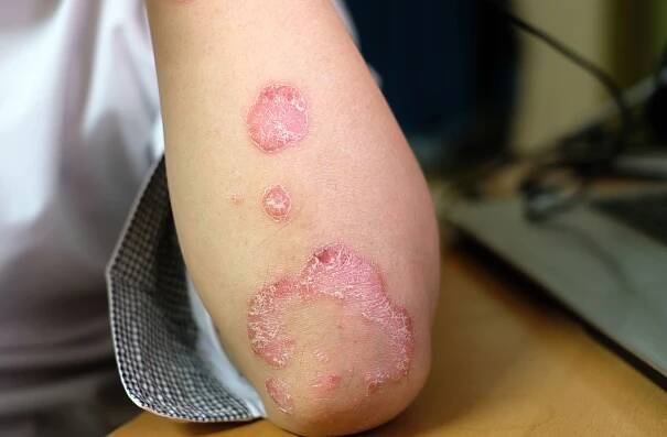 Artax Presents Phase 2a Results of AX-158 for Plaque Psoriasis