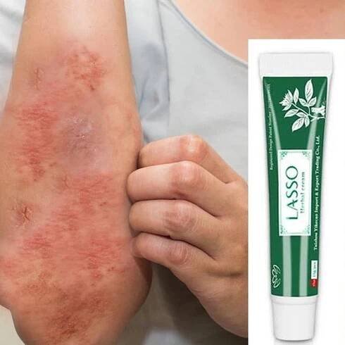 Lasso Herbal Rash Relief Cream – Fast-Acting, Antibacterial & Skin Barrier Support (Buy 3, Get 1 Free!)