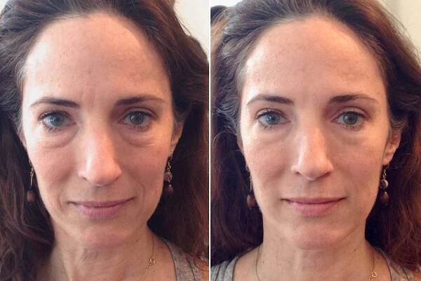 Neinvazivní facelifting obličeje i zpevnění těla