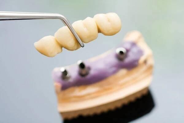 Zubní implantát hlavu a most — Stock Fotografie © Lighthunter #14036761