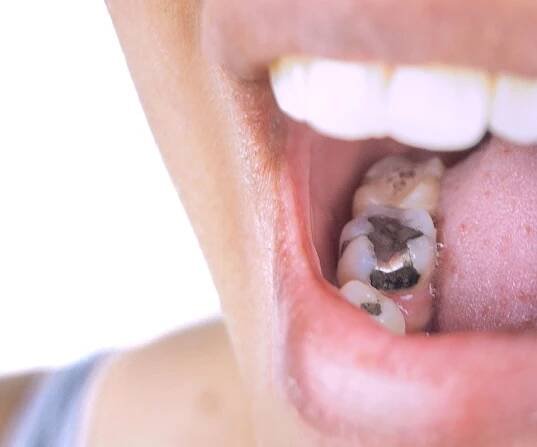 Amalgam Fillings - Empress Walk Dental | General & Specialist Dentistry | North York Dentist