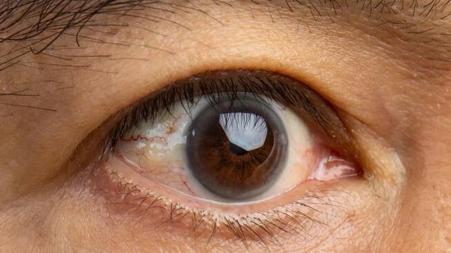 What’s the Difference Between Pinguecula and Pterygium?