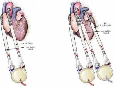Mechanická srdeční podpora | Technika a materiál | Odborník - Kardiochirurgie