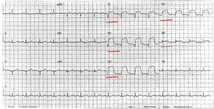 IM přední stěny - EKG | Medicína, nemoci, studium na 1. LF UK