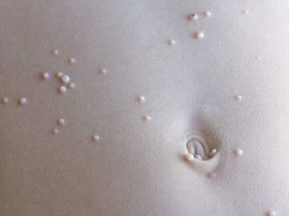 Close up of molluscum contagiosum on the abdomen