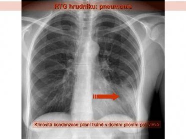 Klínovitá kondenzace plicní tkáně v dolním plicním poli vlevo.