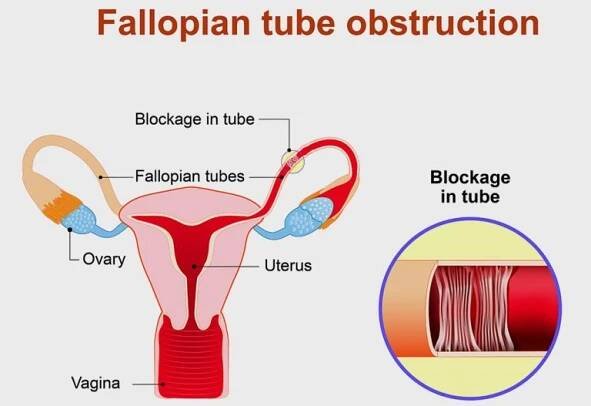 Hydrosalpinx Treatment - How to Unblock Fallopian Tubes Naturally