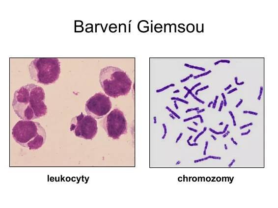 Barvení Giemsou leukocyty chromozomy 