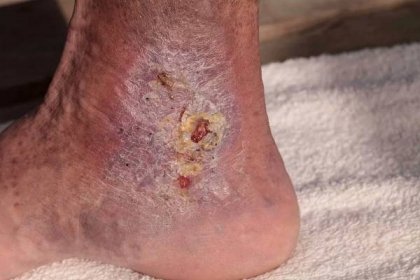 Cellulitis on an ankle