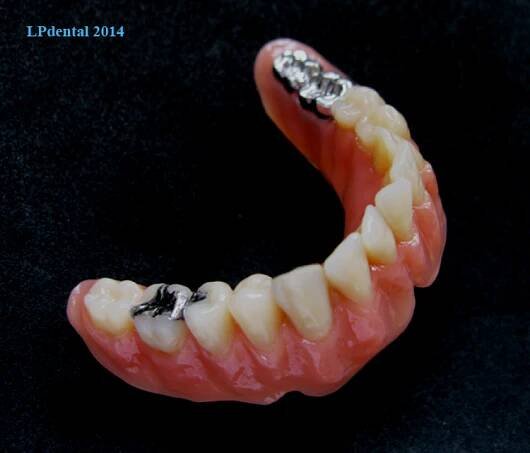 Atypické snímatelné dentální práce | LPdental.cz