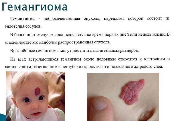 Příznaky hemangiomu, diagnóza, léčba u dětí / Dermatologie | Užitečné informace a tipy na péči o sebe. Zdraví, výživa a