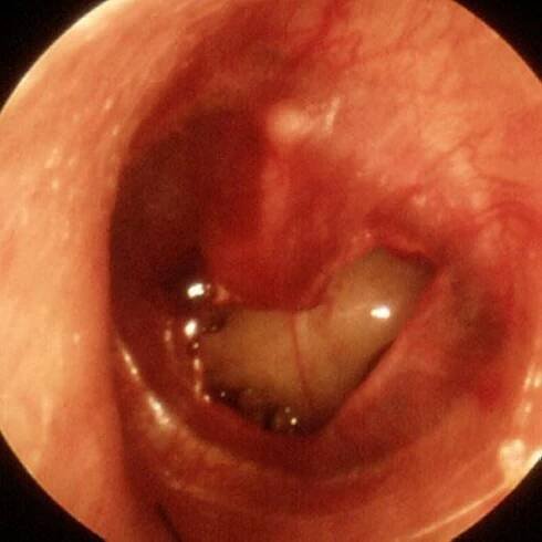Traumatic Perforation of the Tympanic Membrane - Ear, Nose, and Throat Disorders - Merck Manual Professional Edition