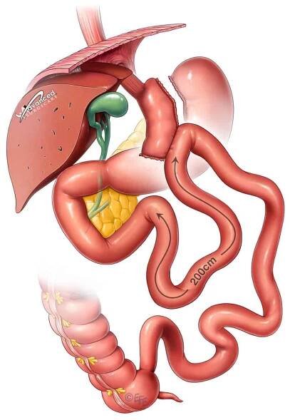 Mini Gastric Bypass Manchester