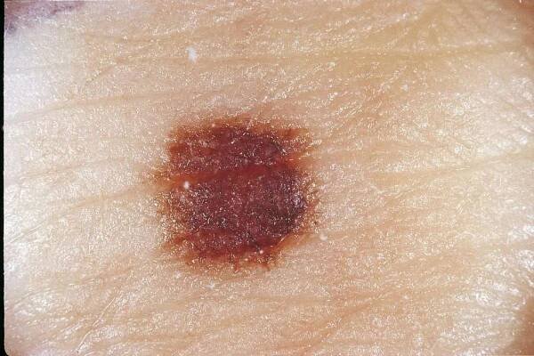 Téměř polovina melanomů vznikne ze znaménka, které se začne měnit – zpočátku často jen nenápadně, a o to je melanom zákeřnější www.dermanet.cz