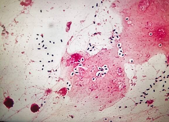 meningitida způsobená streptocuccus pneumoniae - mozkomíšní mok - stock snímky, obrázky a fotky