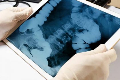 rentgenový obraz střeva v tabletě. gadget v rukou lékaře zblízka. koncept telemedicíny a diagnostiky nemocí - konečník - stock snímky, obrázky a fotky