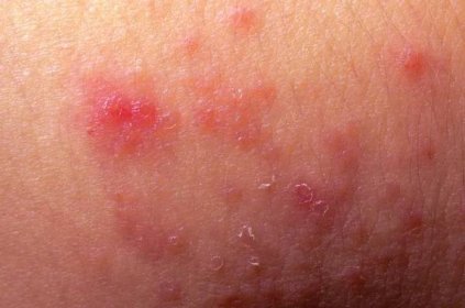 Ekzém atopická dermatitida symptom kůže detail textura — Stock obrázek