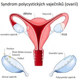 Syndrom polycystických vaječníků (ovarií) - ilustrace