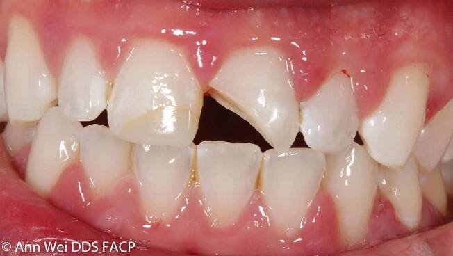 Before-After Pictures - Ann Wei Prosthodontist DDS