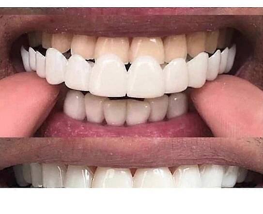 Nový Snap On Smile Zubní falešný kryt zubů Smile Dýhy Comfort Fit F...