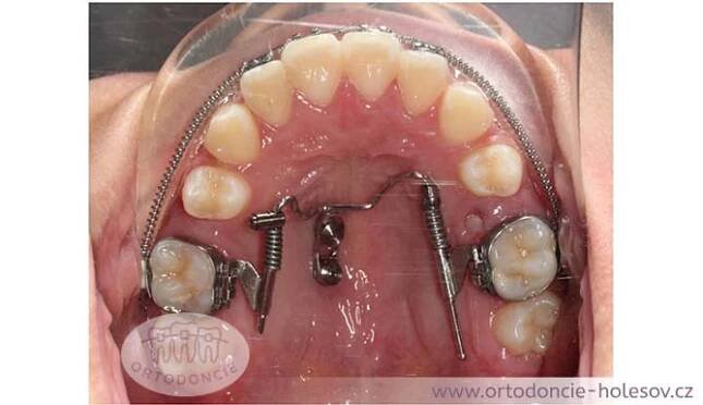 Beneslider mesial/diastal