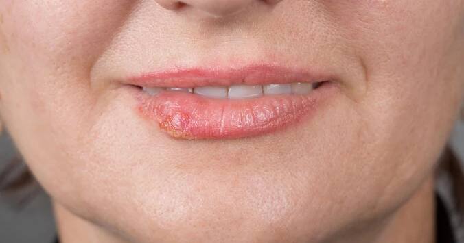 Oparu na rtech se dá snadno zbavit přírodní cestou. Pomůže i aplikace ledu a aloe vera