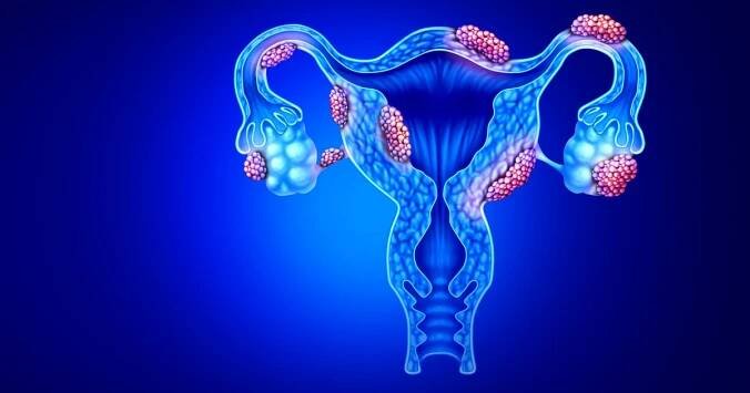 Strávila 10 let v bolestech, než se dočkala správné diagnózy. 95 % žen si tento příznak plete s menstruací