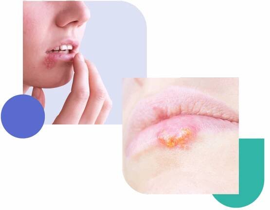 Herpes treatment online