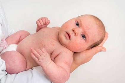 novorozené dítě s kožní vyrážkou. alergická reakce po narození. - baby skin rash - stock snímky, obrázky a fotky
