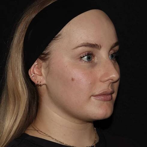 Emface. non-surgical facelift. botox near me. botox longmont. Fillers in longmont.