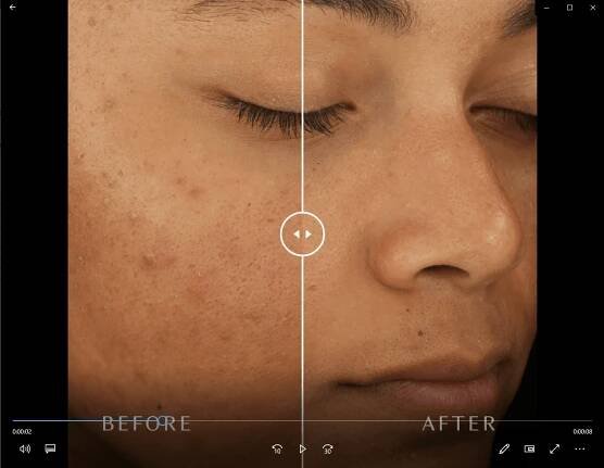 diamond glow by skinmedica before and after face close up