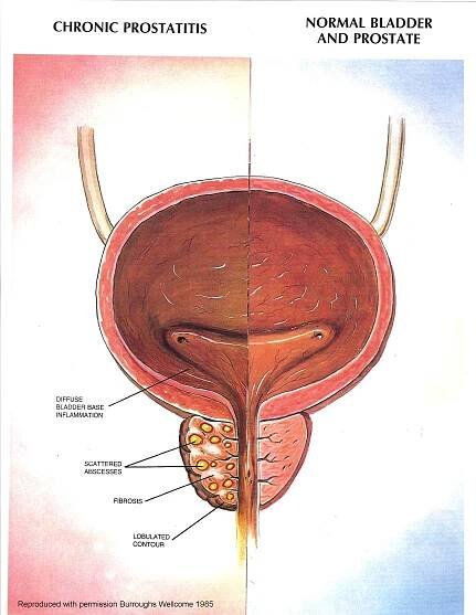 Is chronic prostatitis curable? 