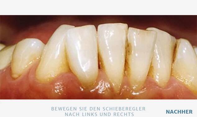 Bleaching