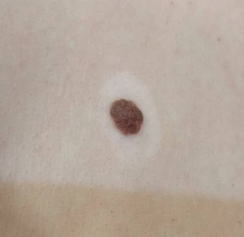 Halo Nevus (ICD-10: D22) - Online consultation AI dermatologist