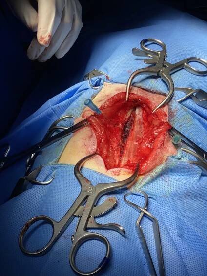 Hemilaminectomy following Hansen type 1 IVDD – Vetrainorg