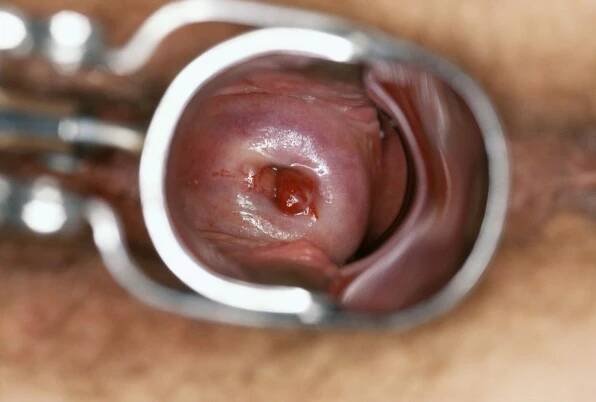 Cervical Polyps - Women's Health Issues - MSD Manual Consumer Version
